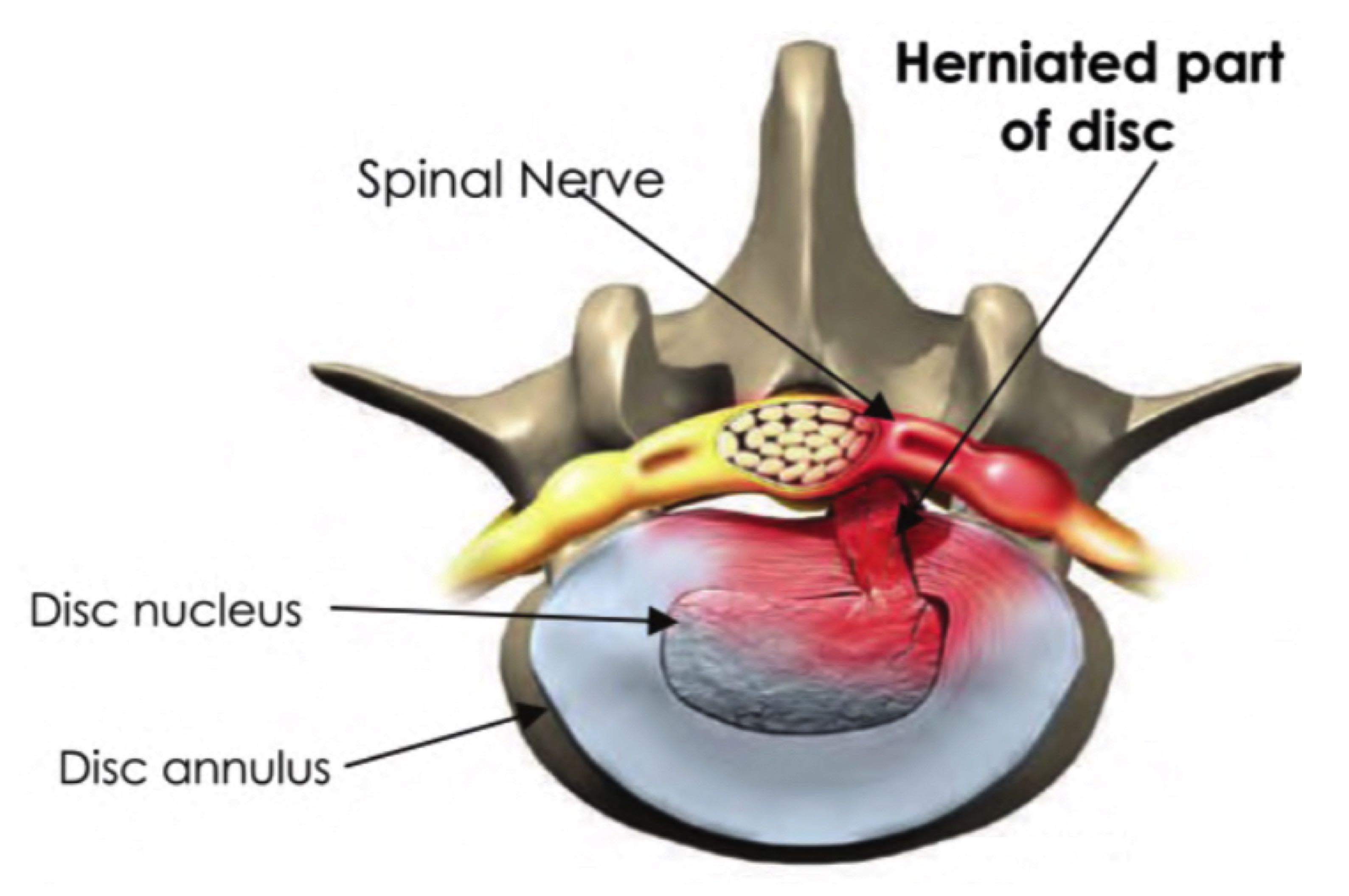 Lumbar spine disc bulge
