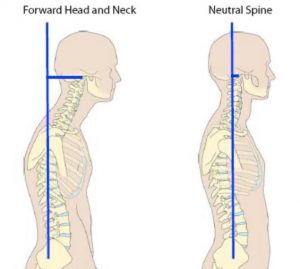 Forward head posture and neck pain