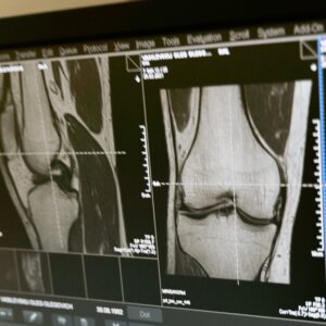 Knee osteoarthritis treatment