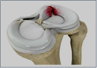 Knee cartilage meniscus injury physio
