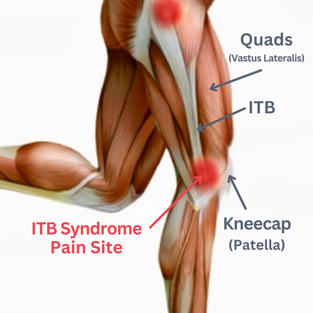 Das Iliotibialband Syndrom Oder Runner S Syndrom YLNZI