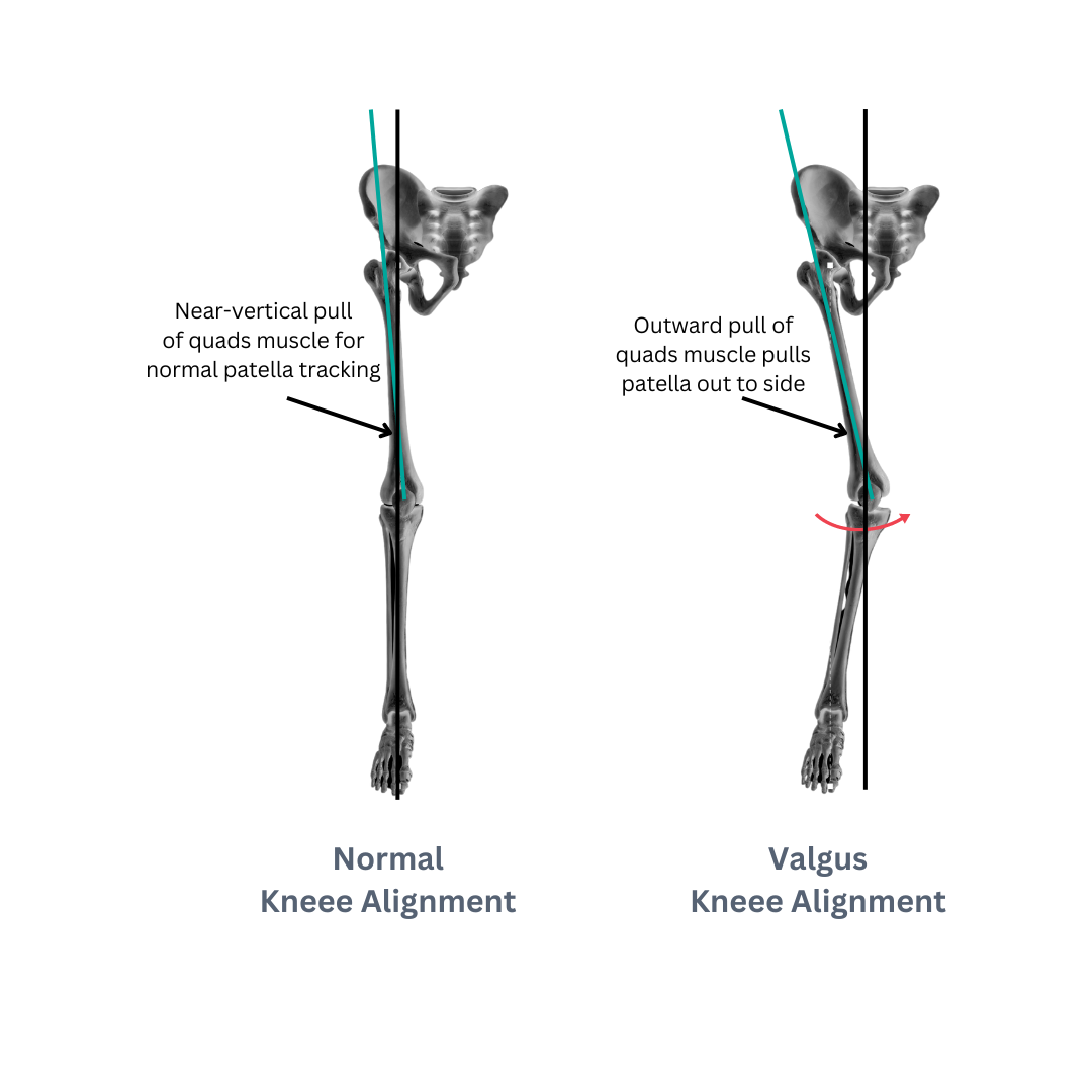 Runner's Knee Which Exercises Work? Central Performance