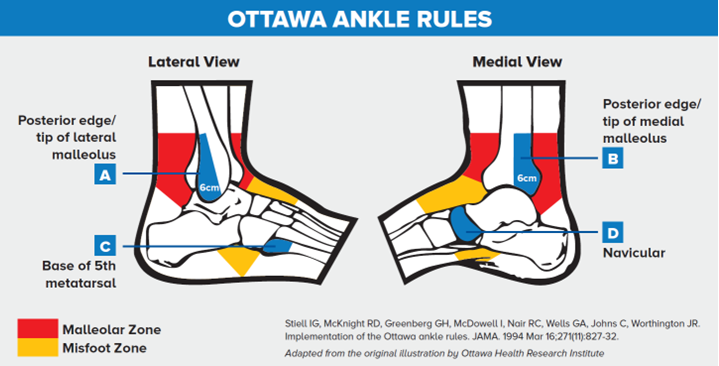 When should I x-ray my ankle? The Ottawa Ankle Rules