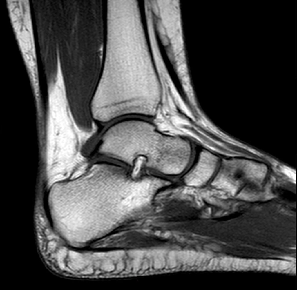 Imaging (xrays, ultrasound, MRI) is not usually required for Achilles tendinopathy pain.